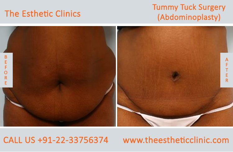 Tummy Tuck Surgery, Abdominoplasty before after photos in mumbai india (6)